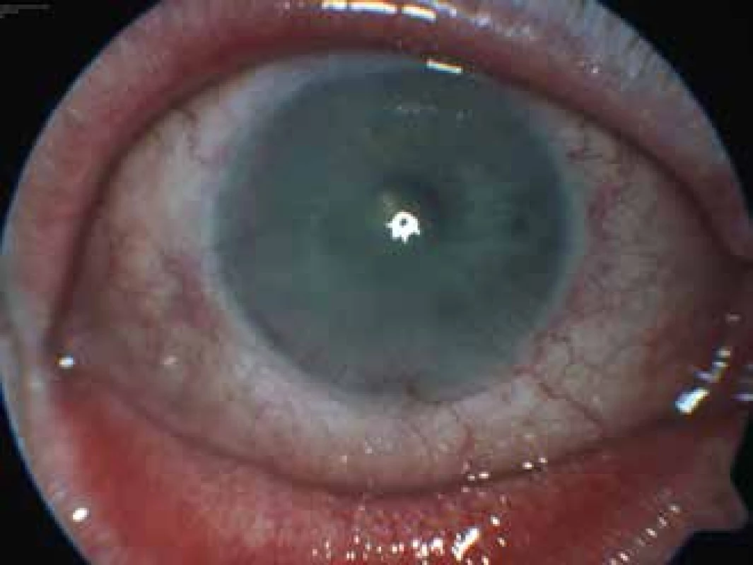 Pravé oko u pacientky z kazustiky 2 se smíšenou injekcí spojivky, semitransparentní rohovkou a perilimbální povrchovou i hlubokou vaskularizací rohovky