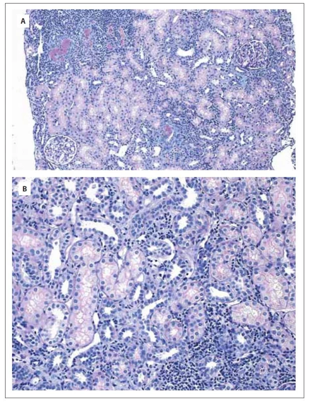 Mikroskopický nález biopsie ledvinného parenchymu v celkovém
zvětšení 100x v kombinovaném barvení PAS + Alcianová modř (A), v celkovém
zvětšení 200x v kombinovaném barvení PAS + Alcianová modř (B).