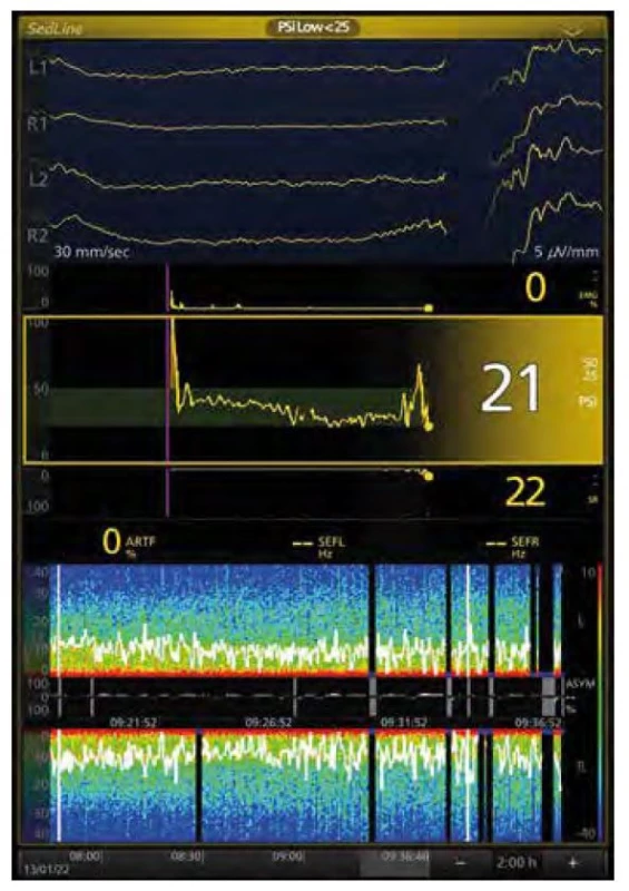 Burst suppression: EEG a spektrogram u 75leté pacientky (propofol,
sufentanil, sevofluran). V horní části syrové EEG křivky, zleva 3 sekundy
isoelektrická linie, v čtvrté sekundě burst, hodnota PSI (Patient State Index)
21, v dolní části Suppression Ratio (SR) 22 (ideálně 0, EEG bez BS), na spektrogramu
za posledních 20 minut v pravé části obraz BS: černé sloupce
s modrou patkou přerušující spektrum