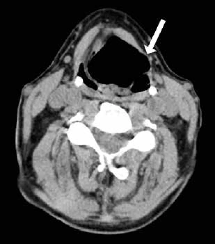 Vnitřní laryngokéla – CT
