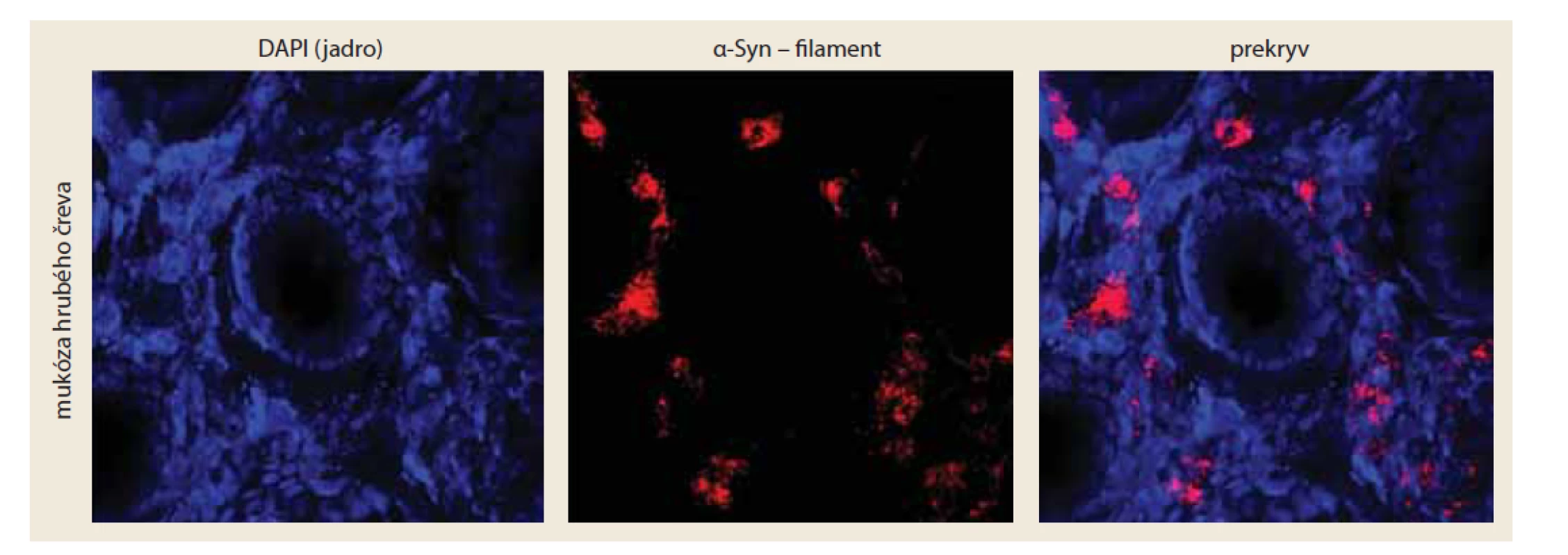 Detekcia patologických foriem α-Syn v celistvých biopsiách hrubého čreva u pacienta s PD. Patologické formy
α-Syn sme detekovali pomocou konformačne-špecifických protilátok proti filamentovej forme α-Syn (červená). Jadrá
buniek (modrá) znázorňujú bunky v mukóze hrubého čreva.<br>
Fig. 2. Detection of pathological forms of α-Syn in wholemount colon biopsies in a patient with PD. Pathological forms of α-
-Syn were detected using conformation-specific antibodies against the filament form of α-Syn (red). Cell nuclei (blue) represent
cells in the colon mucosa.