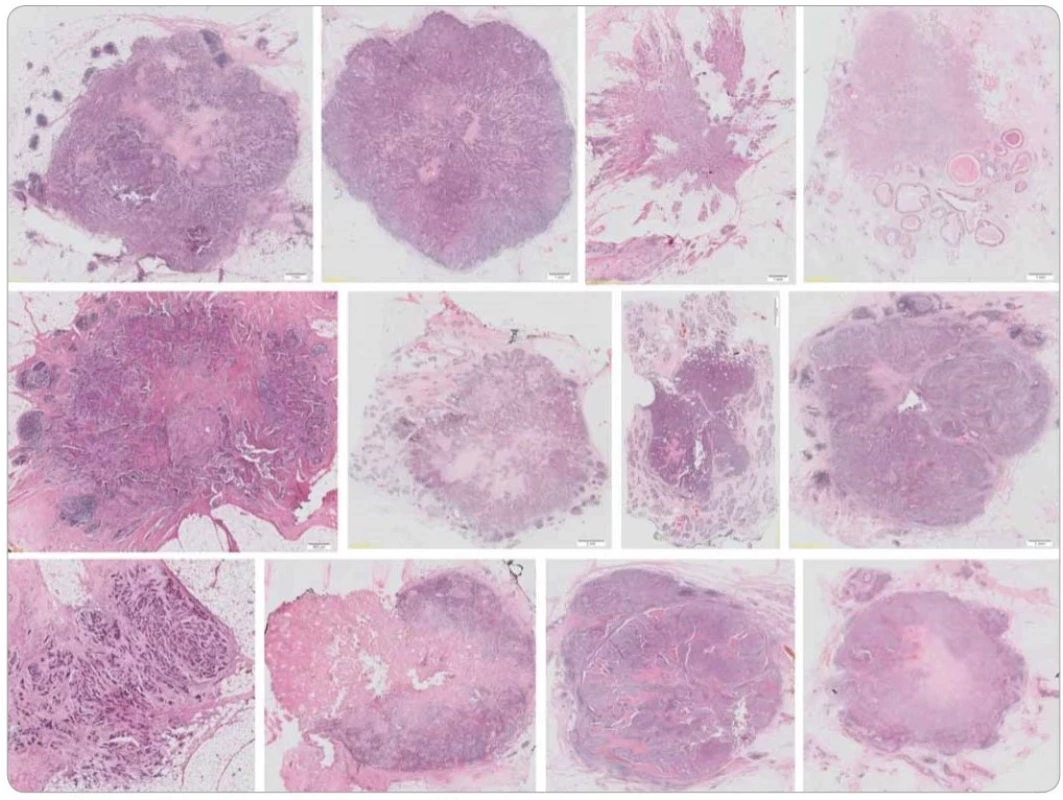 Ukázka typické morfologie karcinomů prsu našeho souboru. Barveno hematoxylinem a eozinem.