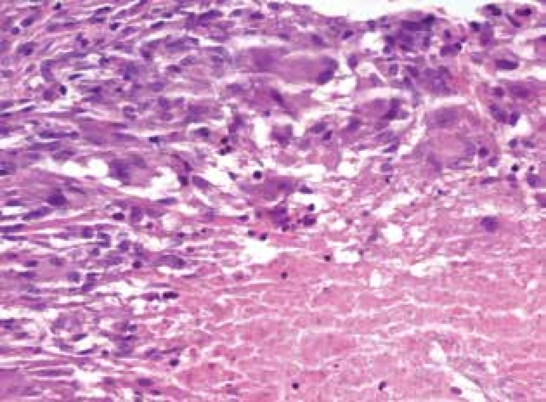 Lupus miliaris disseminatus faciei: okraj kaseifikujícího
granulomu s kaseifikující nekrózou a lemem z histiocytů, i vícejaderných
(HE 400x)