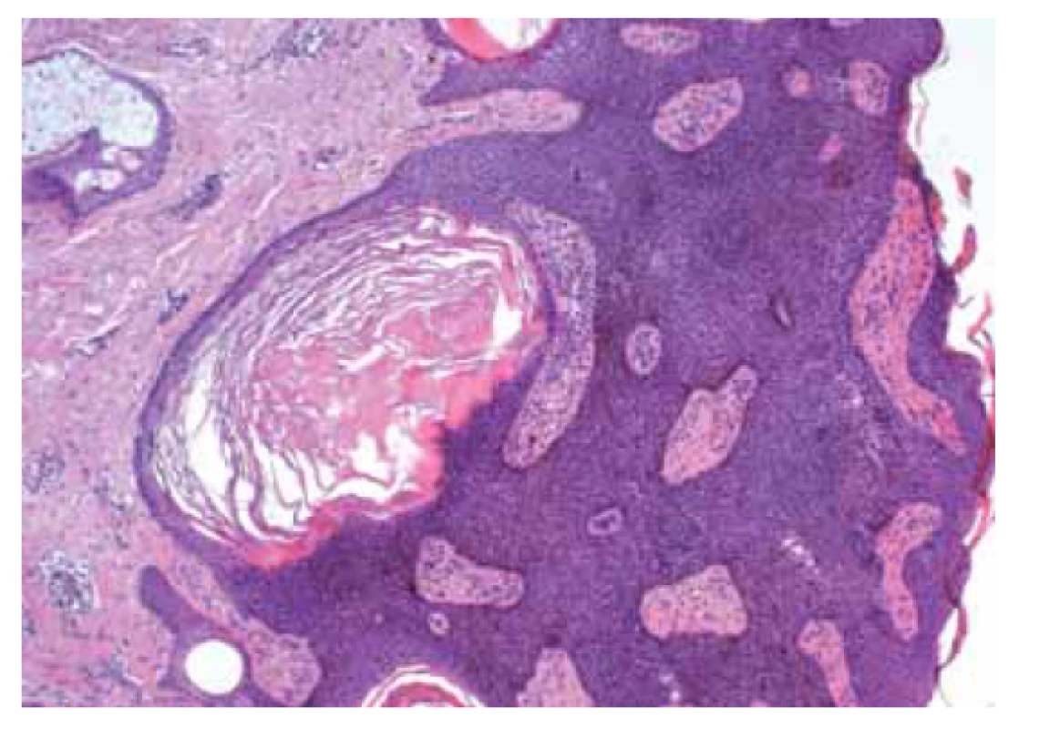 Pigmentovaná seboroická keratóza.<br>
Fig. 4. Pigmented seborrheic keratosis.
