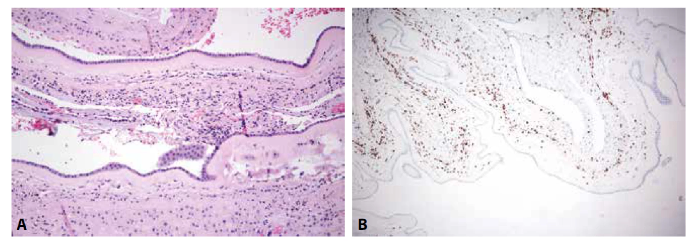 A: Chronická chorioamnionitida plodových obalů (HE, 200x). B: Chronická chorioamnionitida. CD8 pozitivní lymfocyty v chorioamniální
pojivé tkáni (CD8, 100x).