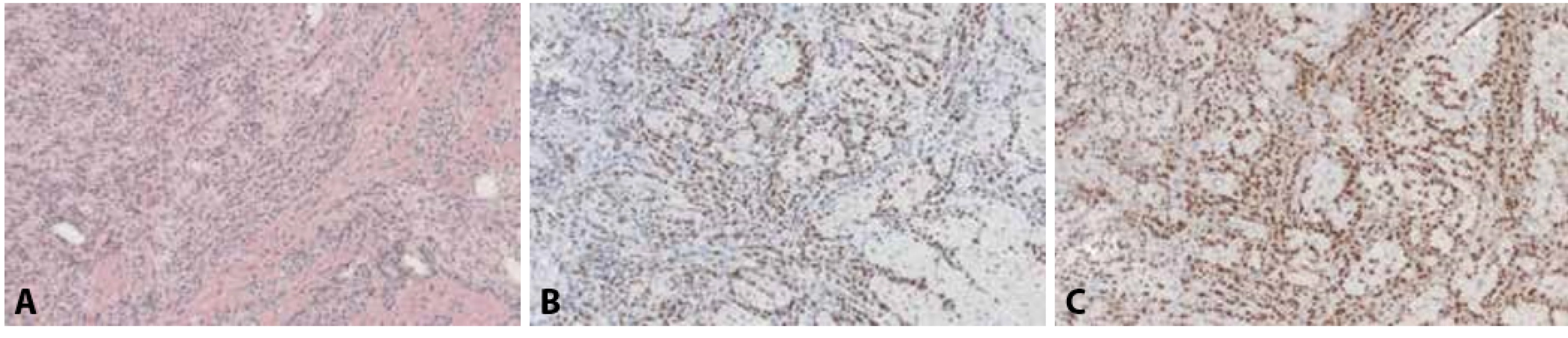 A: Metastatický lobulární karcinom prsu v myokardu, klinicky a na zobrazovacích metodách mimikující myokarditidu (hematoxylin & eosin, 100x). B: Jaderná pozitivita nádorových buněk v imunohistochemickém průkazu antigenu GATA3 (100x). C: Jaderná pozitivita nádorových buněk v imunohistochemickém průkazu estrogenových receptorů (100x).