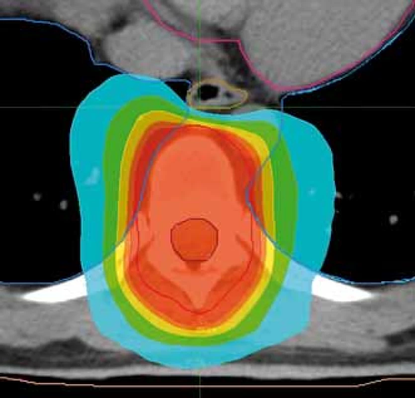 Plán radioterapie na oblast hrudního
obratle s možností nižší dávkové
zátěže jícnu. Předepsaná dávka 30 Gy/10
frakcí. Ozařovací mód TomoHelical, šířka
pole 2,5 cm. Kontury: růžová – srdce, modrá
– plíce, béžová – jícen, hnědá – mícha, červená
– planning target volume. Izodózy: červená
– 95 % předepsané dávky, tyrkysová –
50 % předepsané dávky