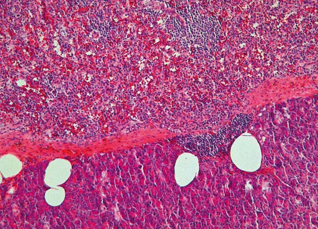 Histologický nález – intrapankreatická akcesorní slezina (IPAS) oddělená
od pankreatické tkáně vazivovým pouzdrem (barvení hematoxylin-eozinem,
zvětšení 100×).
Fig. 2. Histopathological image – intrapancreatic accessory spleen (IPAS) separated
by a fibrous capsule from the pancreatic tissue (Haematoxylin and eosin staining,
magnifi cation 100×).