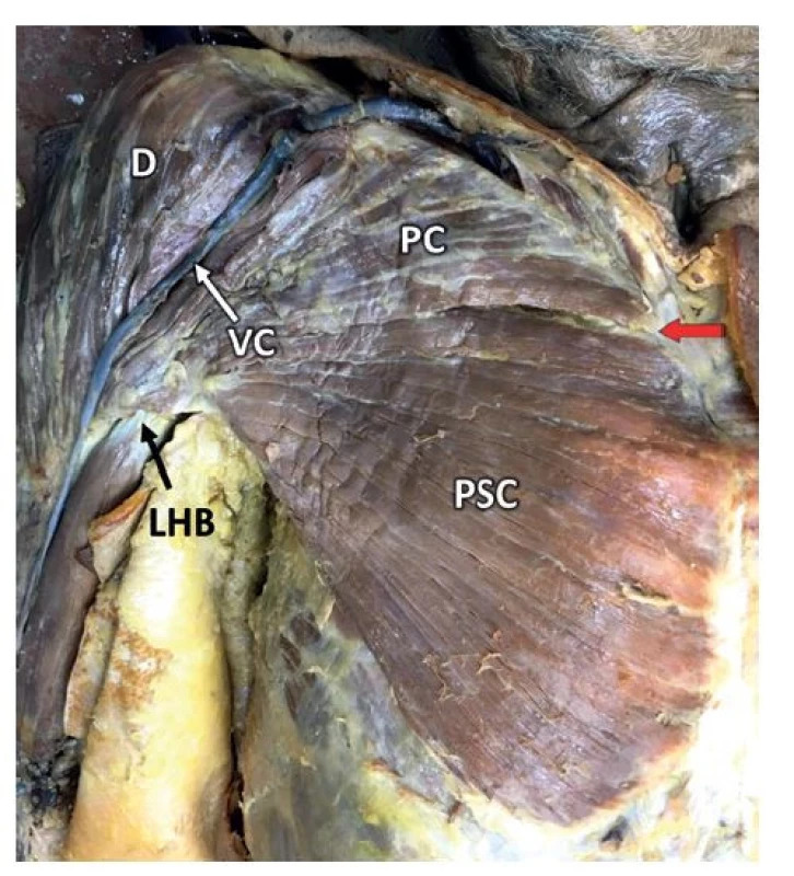 Anatomie m. pectoralis major<br>
Fig. 1: Anatomy of the pectoralis major