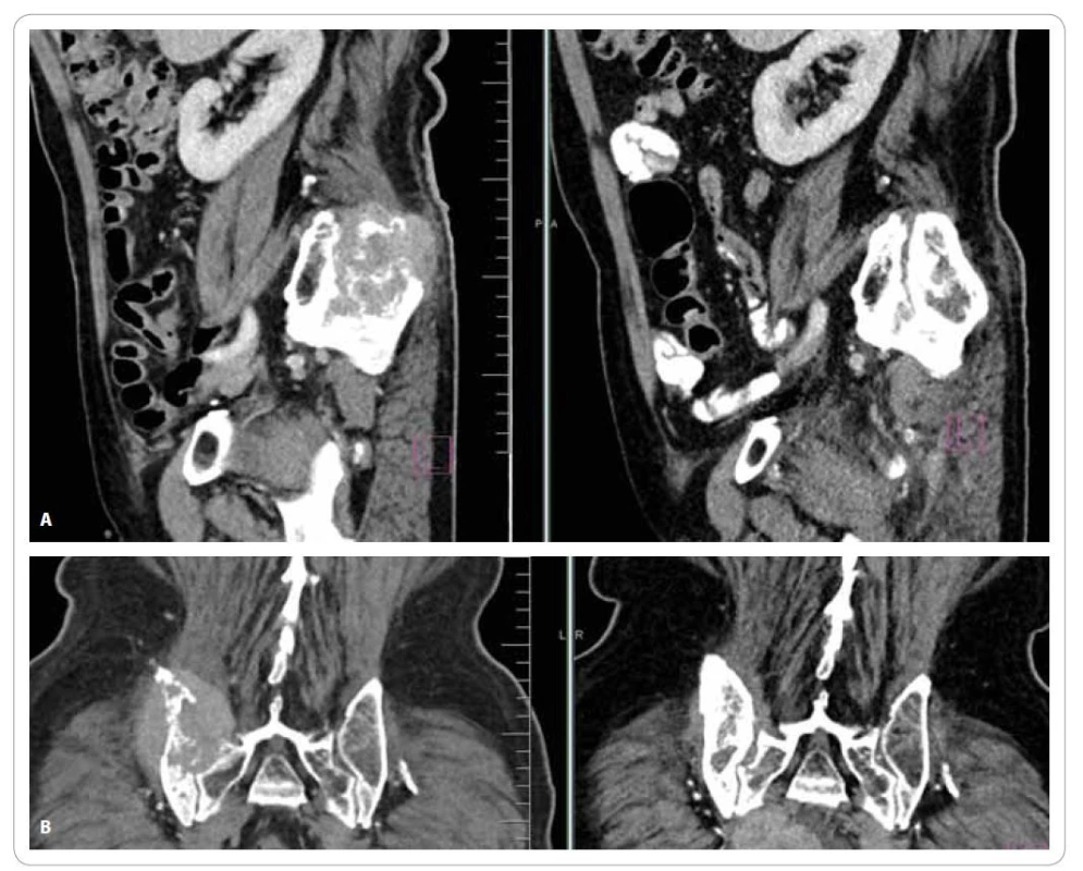 Regrese metastatického ložiska a remineralizace kosti po radioterapii. CT snímky, „kostní okno“. A) sagitální řez; B) koronální řez.