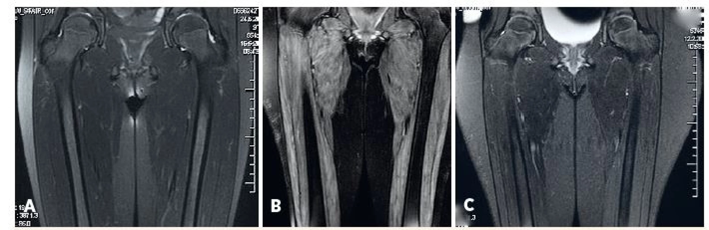 MRI svalov dolného pletenca a stehna.<br>
A) fyziologický nález u pacientky s amyopatickou formou JDM, B) patologický nález u pacientky s floridnou JDM, C) regresia patologických zmien u rovnakej pacientky po liečbe.<br>
Fig. 3. MRI of lower girdle and thigh muscles.<br>
A) physiological findings in amyopathic JDM, B) pahtological findings in active JDM (edema of muscle and subcutis),
C) reversal of pathological findings in the same patient after treatment.