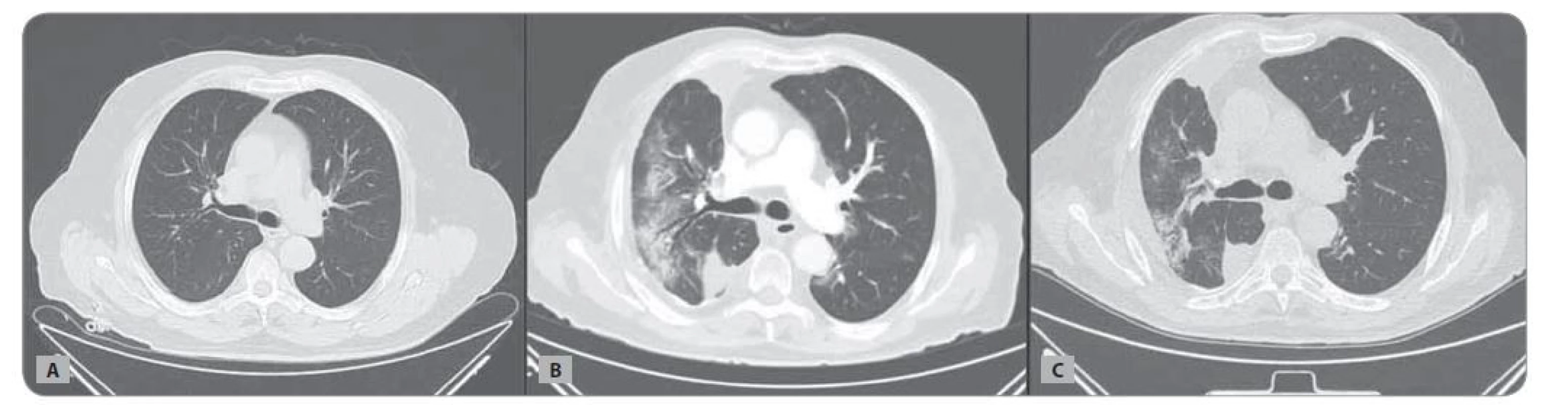 CT hrudníku nemocného z Kazuistiky 1: A) v době zahájení léčby; B) v době pneumonie COVID-19; C) v odstupu 3 měsíců.