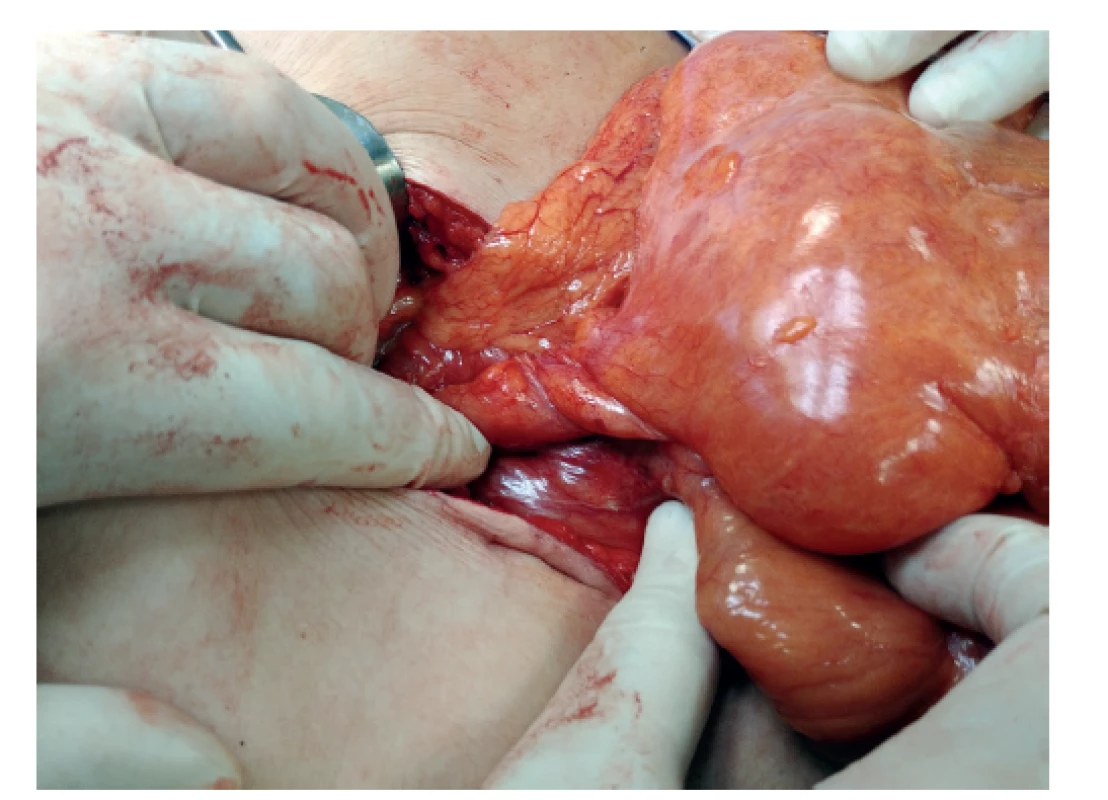 Malrotace – operační nález mesenterium commune<br>
Fig. 2: Malrotation – surgical findings of the common mesentery