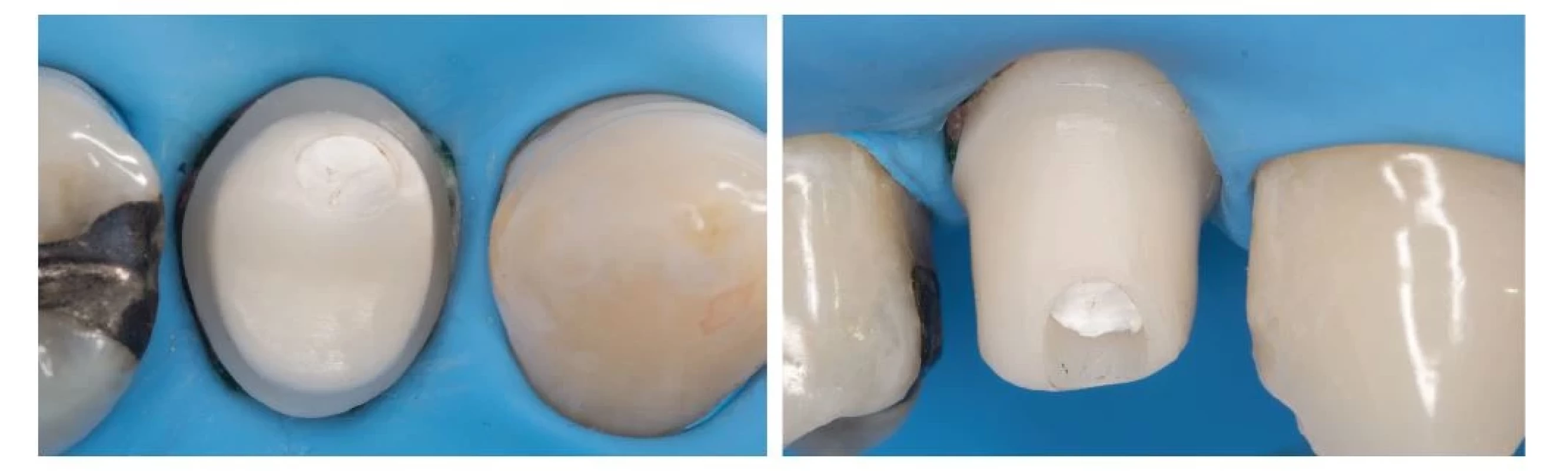 Fixácia korunky na implantát
s použitím kofferdamu
a individálne zhotoveného
ZrO abutmentu.<br>
Fig. 7
Fixation of implant crown
using rubber dam and custommade
zirconia abutment.
