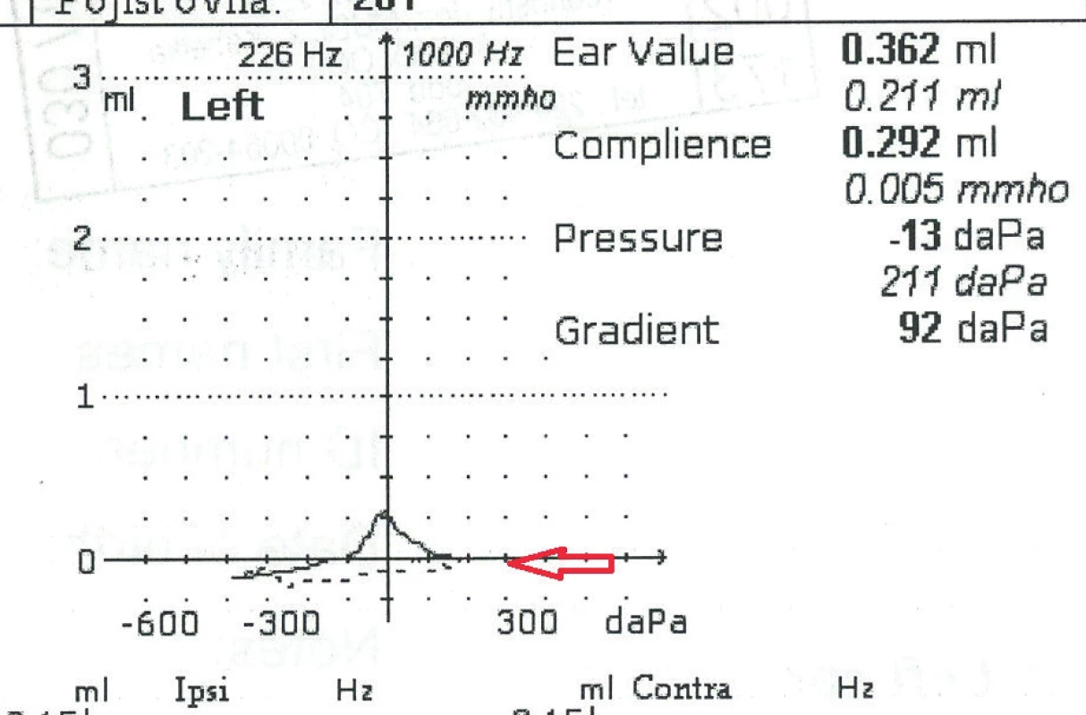 226 Hz (plná čára) a 1 000 Hz (šrafovaná čára)
tympanometrie u pacienta s přítomností středoušního sekretu