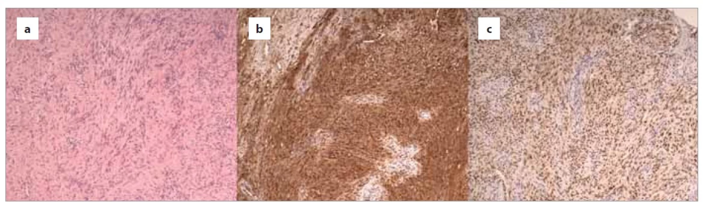 Histologie schwanomu:<br>
a) buněčný vřetenobuněčný tumor s fascikulární morfologii, hematoxylin eozin, 100×;<br>
b) difuzní silná pozitivita proteinu S100, imunohistochemie S100, 100×;<br>
c) difuzní silná pozitivita v SOX0, imunohistochemie SOX10, 100×.<br>
Fig. 4. Histology of schwannoma:<br>
a) cellular spindle tumor with fascicular morphology, hematoxylin eosin, 100×;<br>
b) diffuse strong positivity of protein S100, immunohistochemistry S100, 100×;<br>
c) diffuse strong positivity of SOX0, immunohistochemistry SOX10, 100×.