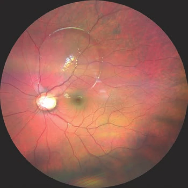 Photograph of fundus of left eye, ODP with serous
ablation of neuroretina superotemporally