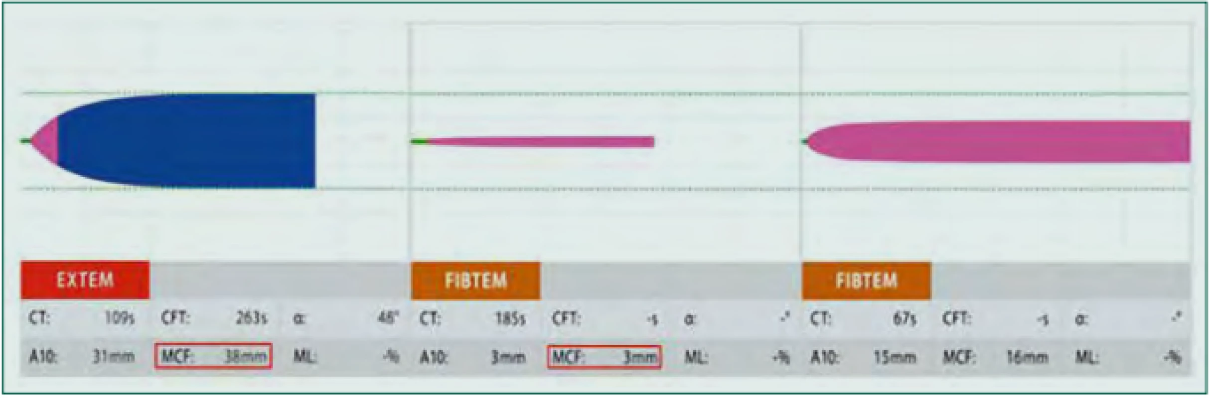 Deficit fibrinogenu a trombocytů: Vlevo patologická křivka vyšetření EXTEM se snížením parametru MCFEXTEM (červený rámeček, normální hodnoty
50–72 mm), které může značit deficit fibrinogenu či trombocytů. K odlišení je proveden test FIBTEM – snížení parametru MCFFIBTEM (červený rámeček, normální
hodnoty 9–25 mm) představuje deficit funkčního fibrinogenu, normální hodnota tohoto parametru pak deficit funkčních trombocytů.