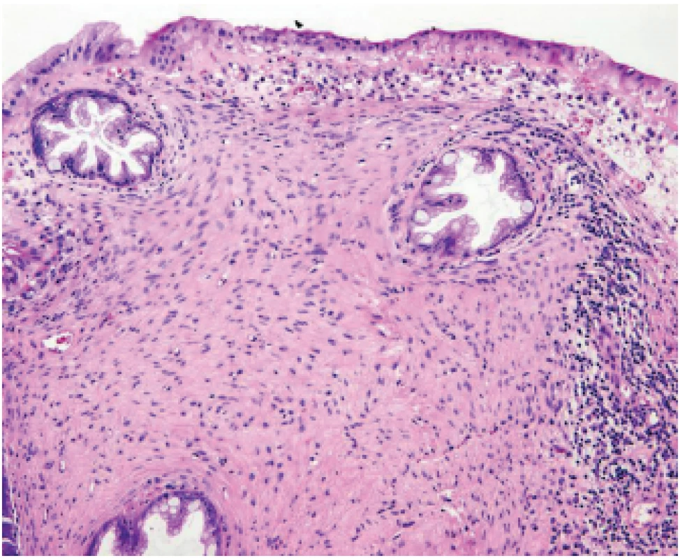 Slizniční perineurinom. Okolo krypt s pilovitým profi lem lumina je
výrazná proliferace vřetenitých eosinofi lních buněk (HE, 100x).