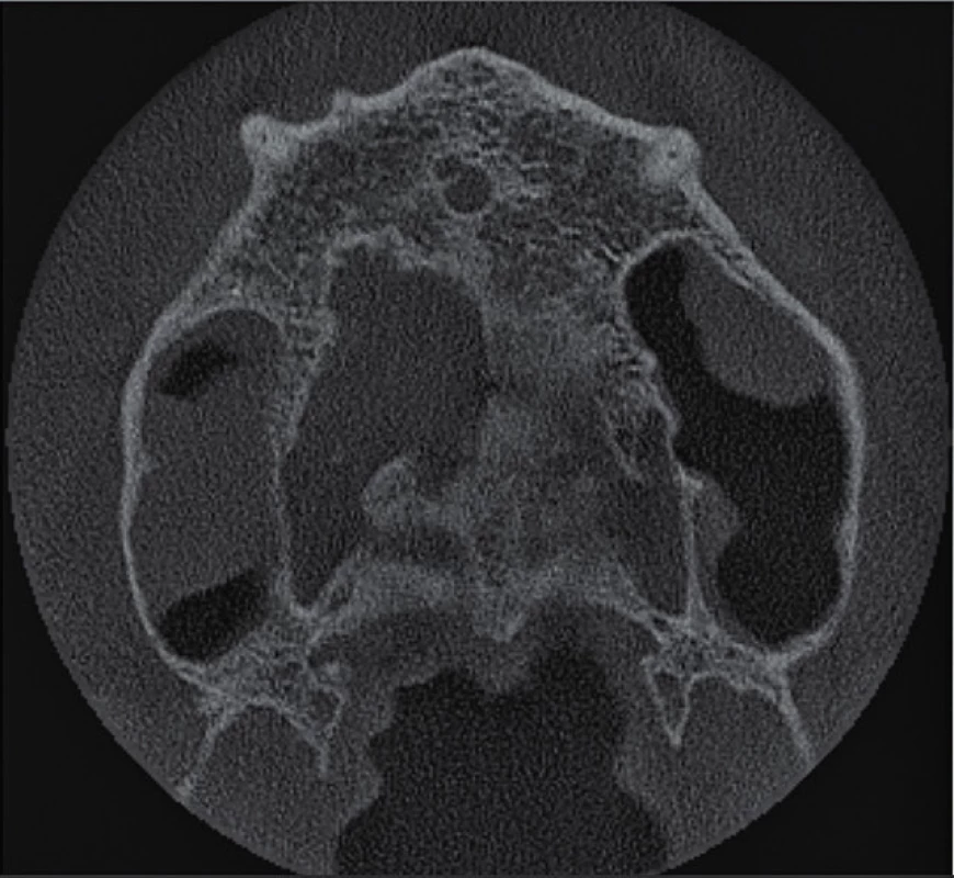 Horizontální řez
CBCT snímku nad hroty
kořenů horních středních
řezáků. Není přítomno periapikální
projasnění
u zubu 11