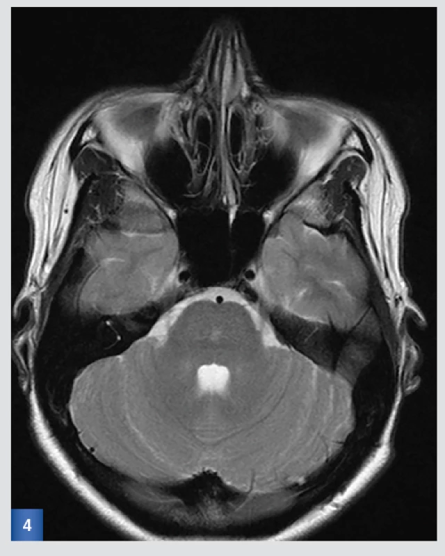 Kontrolní MRI po 3 měsících:T2-vážený obraz