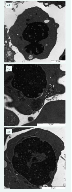 Změny typické pro CDA v elektronovém
mikroskopu – pacientka s CDA IV: 4.1 – jaderný
můstek v erytroblastu a defekty chromatinu
(„spongychromatin“) 4.2 – „spongychromatin“,
atypické lamelární tělísko, siderosom
4.3 – intermediární atypická cisterna v erytroblastu