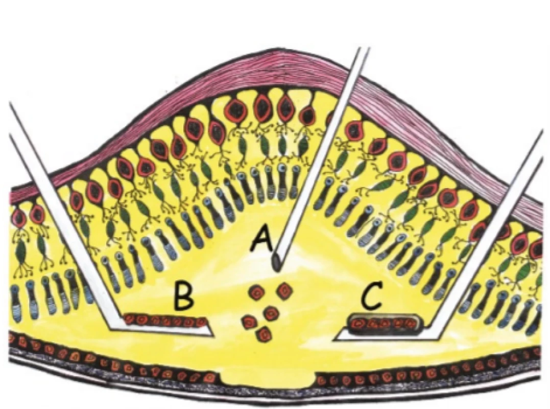 Surgical technique of retinal pigment epithelium
transplantation. Application of cellular suspension (A), self- -supporting cell plate (B), cell plate on artificial supporting
carrier (C)