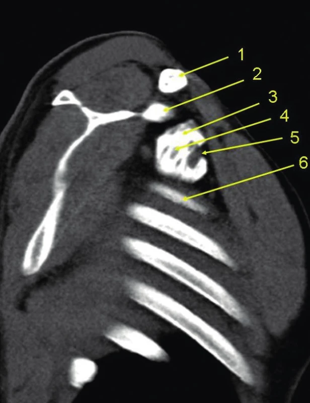 CT šikmý řez axilou s náplní pochvy brachiálního
plexu<br>
1 – klíční kost, 2 – korakoidní výběžek, 3 – tekutina v pochvě
brachiálního plexu, 4 – nerv, 5 – a. subclavie, 6 – první žebro