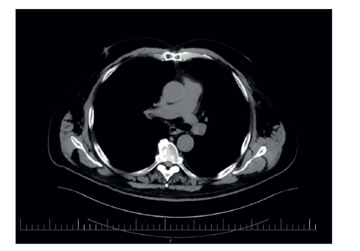 Pooperačný stav – pľúcnica bez trombu<br>
Fig. 9: Postoperative condition – pulmonary artery without
the thrombus