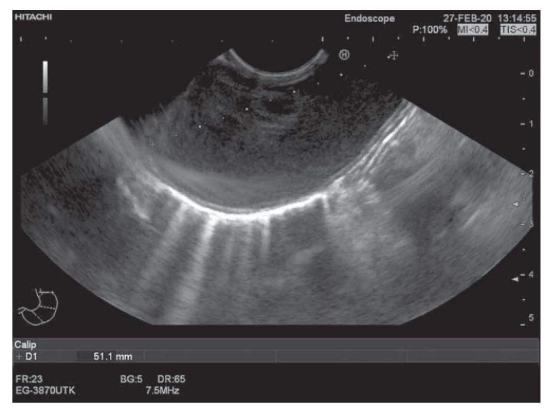 Duplikačná cysta ezofágu: EUS obraz.<br>
Fig. 2. Duplicative esophageal cyst: EUS image.