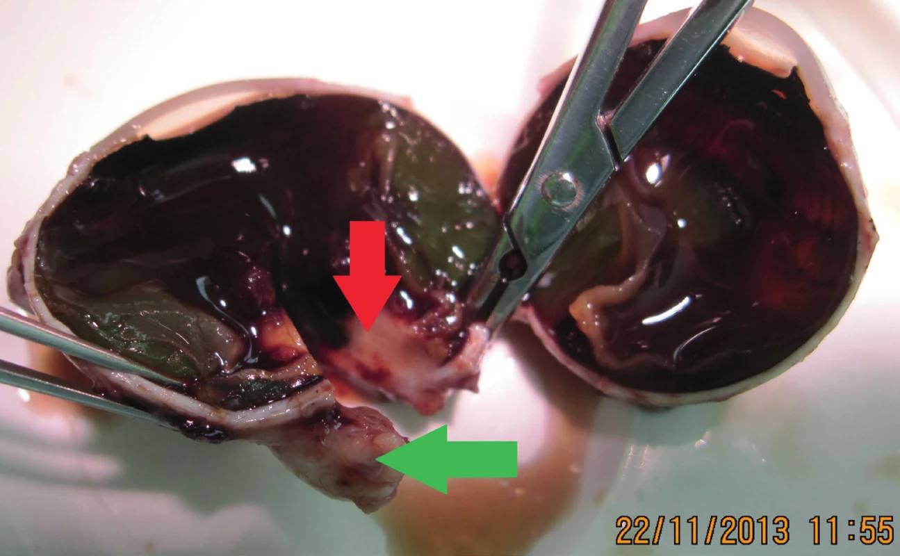 Eyeball after enucleation – red arrow indicates tumour deposit and green
arrow disc of optic nerve