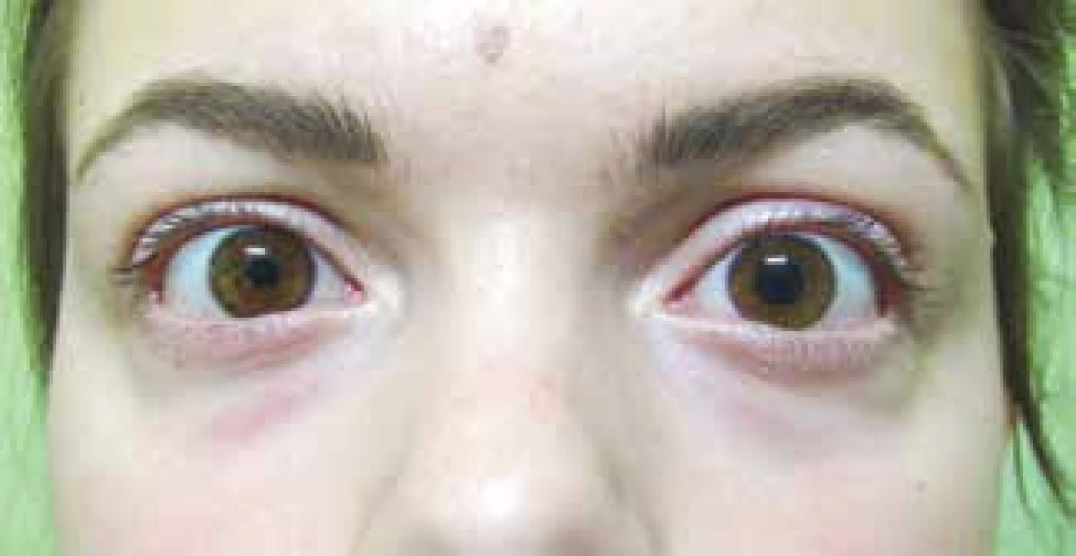Negative result of pharmacological test with
application of 0.1% Pilocarpine in left eye