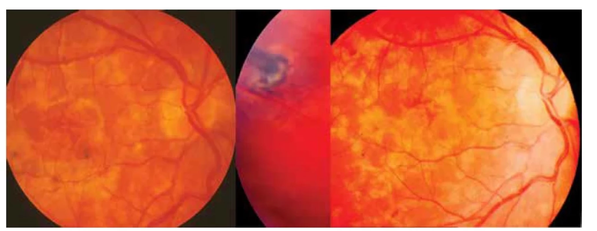 Vlevo: Klinický obraz prosáknutí centrální oblasti zadního pólu oka při DUSN toxokarové etiologie<br>
Uprostřed: Ojedinělá chorioretinální jizva v.s. po hlístu v průměru 1 PD s pigmentovou trakcí v temporální periferii po
kombinované léčbě<br>
Vpravo: Mapovité žlutavé zajizvení sítnice doprovázené částečnou atrofií zrakového nervu o půl roku později po kombinované
léčbě