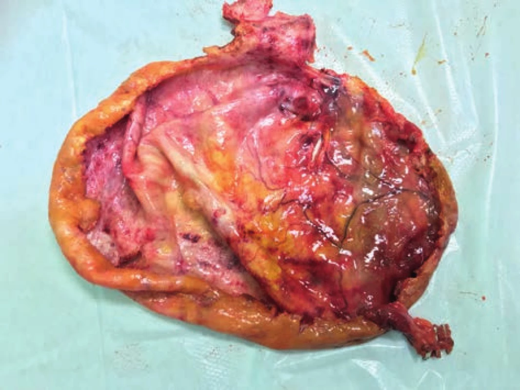 Stěna cysty en-block se žlučníkem<br>
Fig. 1: The wall of a liver cyst en-block with the gallbladder