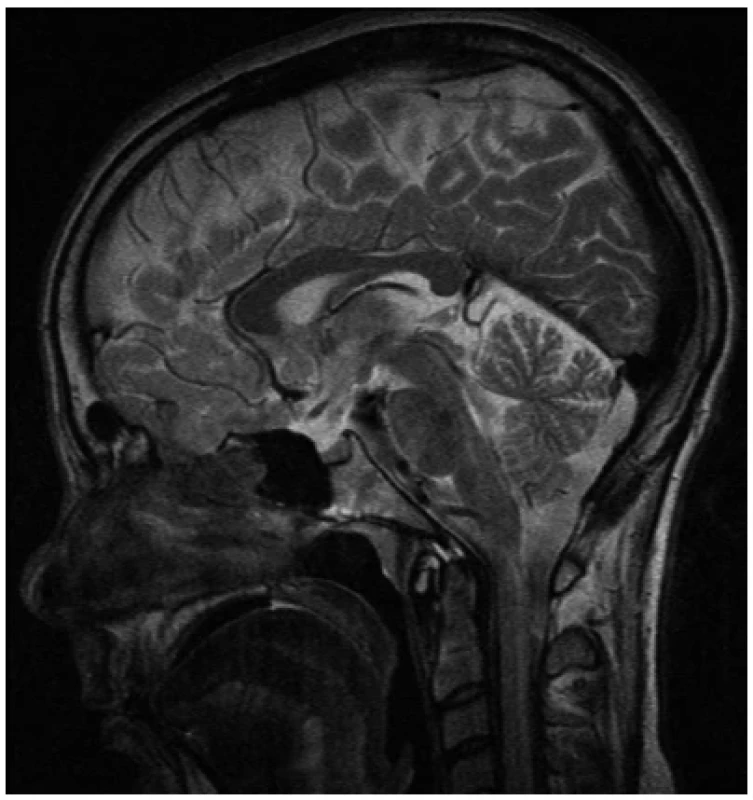 Magnetická rezonance mozku – normální nález na hypofýze <br> 
Fig. 1. Magnetic resonance imaging of the brain – normal findings on the pituitary gland