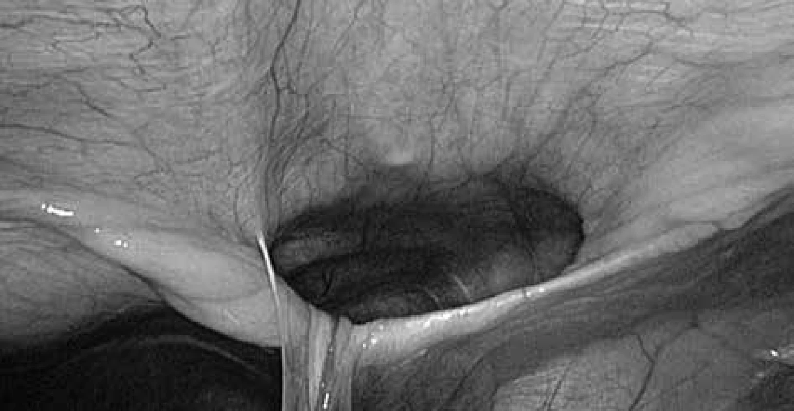 Morgagniho kýla při laparoskopii, ligamentum teres hepatis vtaženo do defektu v bránici<br>
Fig. 5: Laparoscopical view of Morgagni hernia, ligamentum teres hepatis in the diaphragmatic defect 