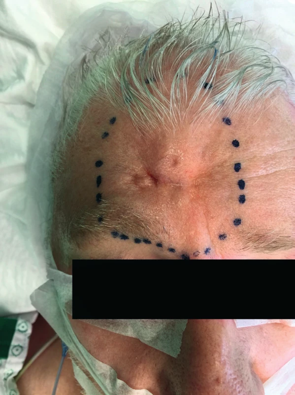 Preoperative state, large indurated lesion in the right
frontal area of the forehead