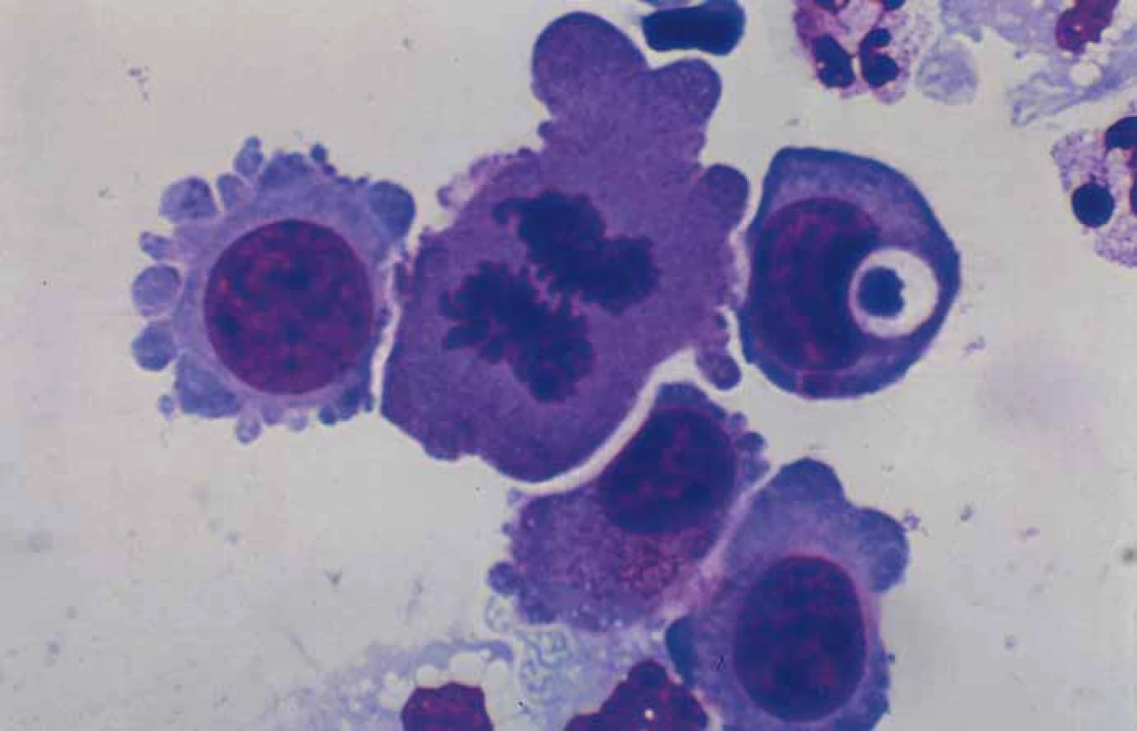 Cytology in cerebrospinal fluid.