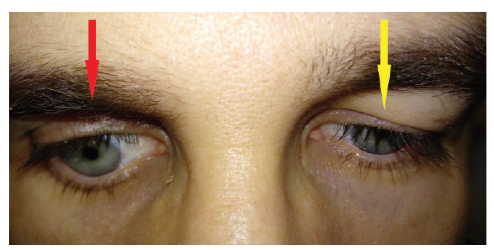Retraction of the right upper eyelid with Graefe’s sign