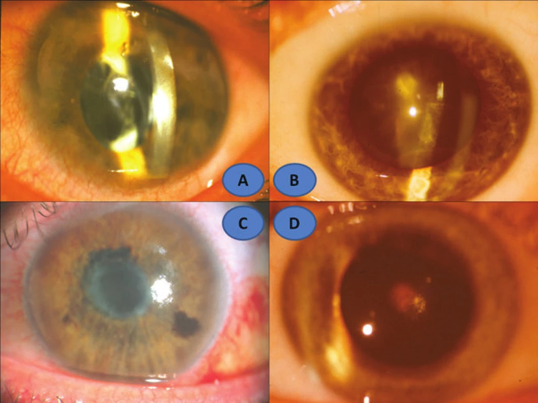 Clinical picture of anterior segment of sympathising eye: 16 year old consulted patient
(A), patient no. 3 (B), patient no. 5 (D), patient no. 6 (C)