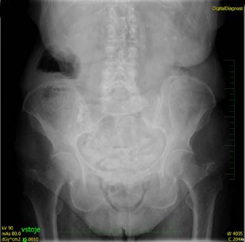 Rtg břicha, přítomnost plynu v malé pánvi<br>
Fig. 1. Abdominal X-ray with presence of gas in small
pelvis