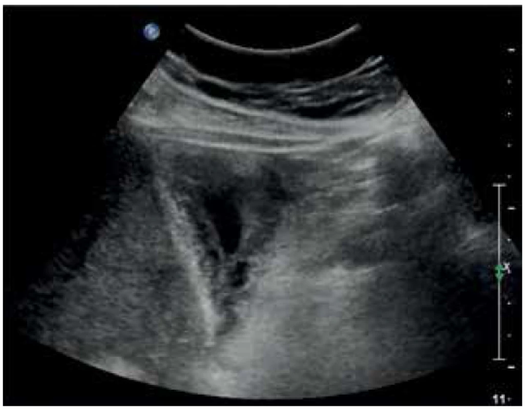 Zesílená stěna žlučníku na 14 mm v rámci akutní
cholecystitidy<br>
Fig. 6. Gallbladder wall thickened to 14 mm in acute cholecystitis