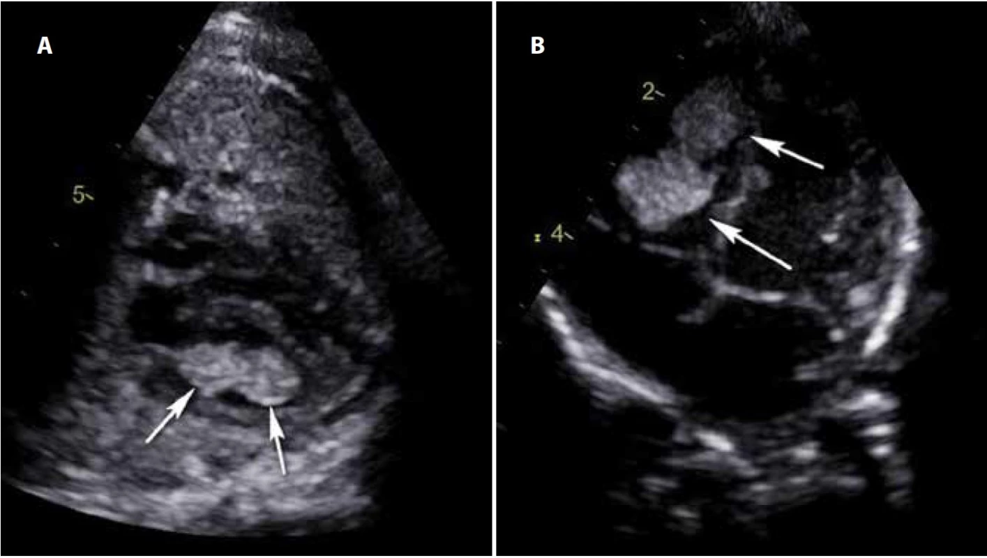 Rhabdomyom, echokardiografie, fetální (a) a postnatální (b) nález.<br>
Fig. 2. Rhabdomyoma, echocardiography, fetal (a), and postnatal (b) findings.