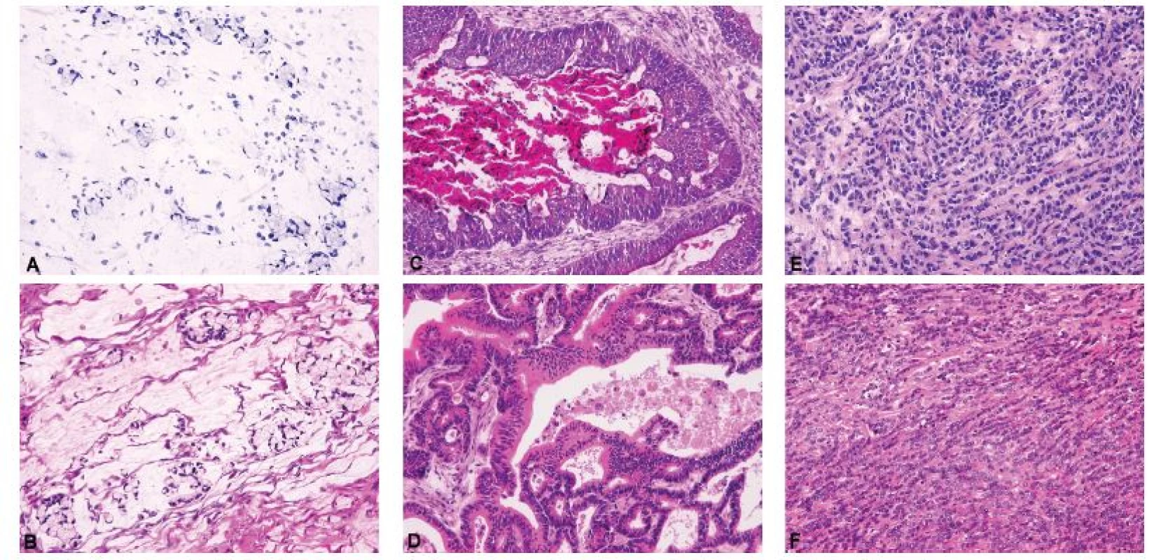 Široké morfologické spektrum metastatických karcinomů do ovaria.<br>
A – metastatický špatně kohezivní adenokarcinom žaludku s výraznou extracelulární hlenotvorbou a stromálními jezírky hlenu (Krukenbergův nádor) (peroperačně
hlášeno jako metastatický adenokarcinom nejspíše z gastrointestinálního traktu) (peroperační vyšetření, HE, 200x); B – metastatický špatně kohezivní
adenokarcinom žaludku s výraznou extracelulární hlenotvorbou a stromálními jezírky hlenu (Krukenbergův nádor) (definitivní vyšetření, HE, 200x); C – metastatický
adenokarcinom tlustého střeva (peroperačně hlášeno jako vysoce suspektní metastatický adenokarcinom nejspíše z tlustého střeva, nicméně diferenciálně
diagnosticky nelze jednoznačně vyloučit primární nebo metastatický endometroidní karcinom) (peroperační vyšetření, HE, 200x); D – metastatický
adenokarcinom tlustého střeva (definitivní vyšetření, HE, 200x); E – metastatický lobulární karcinom mléčné žlázy (peroperačně hlášeno jako metastatický
adenokarcinom nejspíše z mléčné žlázy anebo z gastrointestinálního traktu) (peroperační vyšetření, HE, 200x); F – metastatický lobulární karcinom mléčné
žlázy (definitivní vyšetření, HE, 200x)
