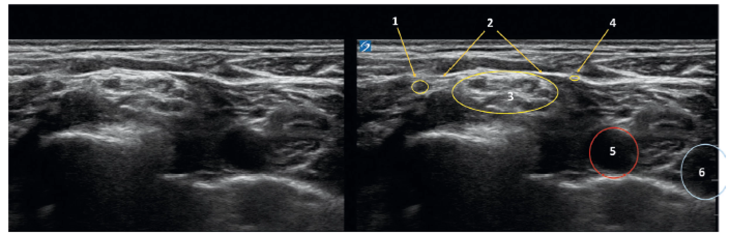 Ultrazvukový obraz krku v úrovni C 6.7
1 – levý supraskapulární nerv, 2 – fascie k m. omohyoideus, 3 – brachiální plexus, 4 – n. subclavius, 5 – arteria carotis, 6 – v. jugularis