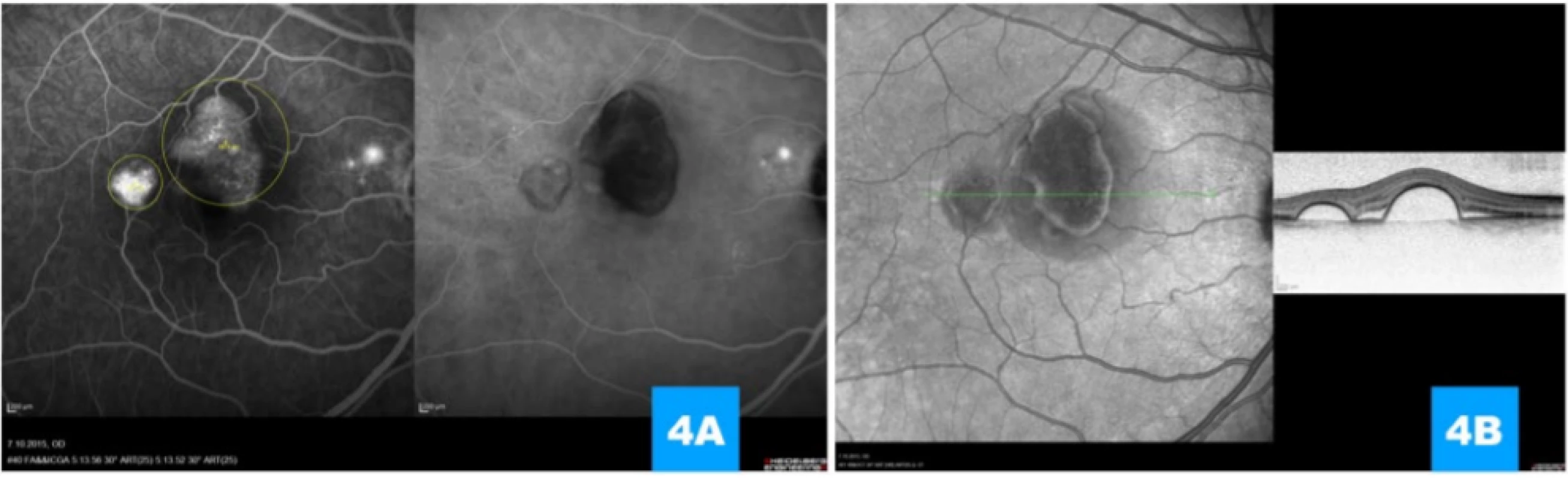  (A) Simultaneous image of fluorescence and indocyanine angiography illustrating late hyperfluorescence (pooling)
beneath ablations of the retinal pigment epithelium, minor deposit of hyperfluorescence in the parapapillary region, indication of size and location of beams for photodynamic therapy (yellow outlining); there is clear gradation of the filling of
the choroidea beneath serous ablations, at the same time the image excludes the presence of choroidal neovascularisation.