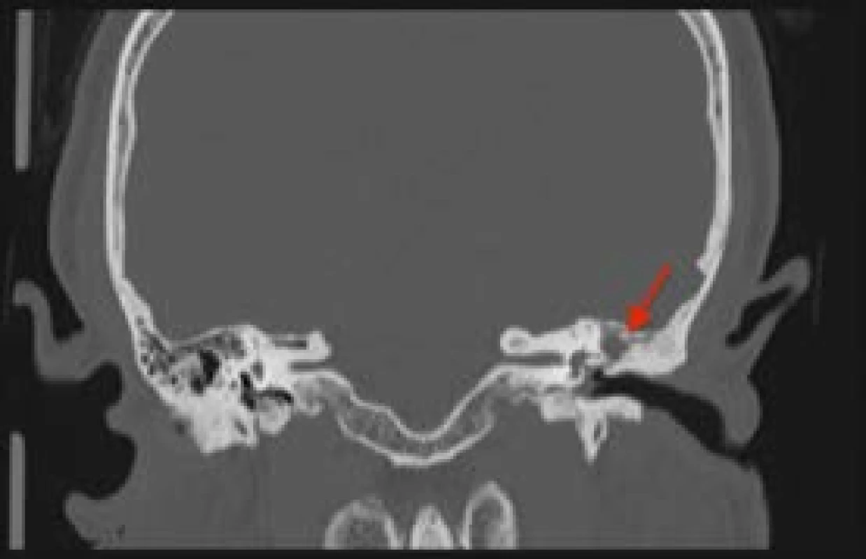 HRCT spánkové kosti, koronární řez: muž, 62 let, levé ucho,
hypodenzní zastření v oblasti atiku s naznačenou osteolýzou
(červená šipka)
