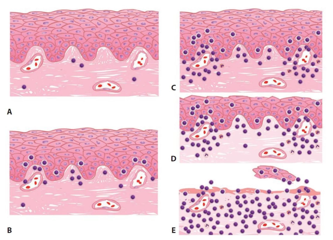 Schéma provizorního skórovacího systému rejekčních změn po UTx.<br>
A) Normální cervikální biopsie s izolovanými zánětlivými buňkami. B) Borderline změny definované shlukujícími se zánětlivými buňkami s převahou
lymfocytů v oblasti epitelo-stromální junkce s intraepiteliálním influxem leukocytů. C) Grade 1 rejekce charakterizovaná ložiskovým smíšeným
zánětlivým infiltrátem s převahou lymfocytů v oblasti epitelo-stromální junkce. D) Grade 2 rejekce charakterizovaná ložiskovým až splývajícím
smíšeným zánětlivým infiltrátem s převahou lymfocytů v oblasti epitelo-stromální junkce, doprovázená redukcí šíře epitelu a stromálním
edémem. E) Grade 3 rejekce s nápadným difuzním smíšeným zánětlivým infiltrátem. Epiteliální eroze/ulcerace mohou být přítomny.