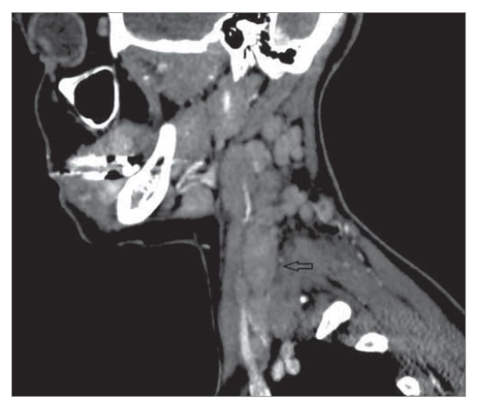 CT sken krku odhaľuje zväčšené lymfatické uzliny
pozdĺž m. sternocleidomastoideus vľavo (sagitálny rez).<br>
Fig. 3. A CT scan of the neck reveals enlarged lymph
nodes along the left sternocleidomastoid muscle
(sagittal section).