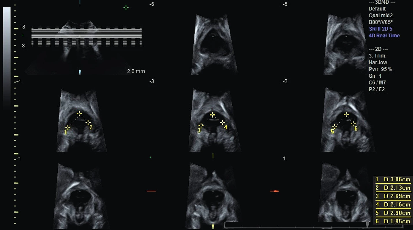 Sonografická tomografie (TUI) a hodnocení avulze MLA ve
třech centrálních snímcích pomocí vzdálenosti levator-urethra gap